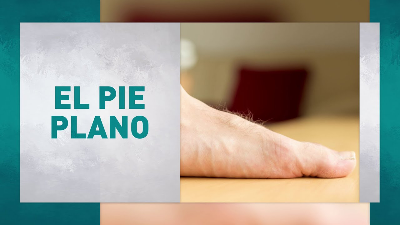 como saber si tengo pie plano