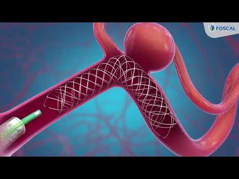 como se ve un aneurisma cerebral