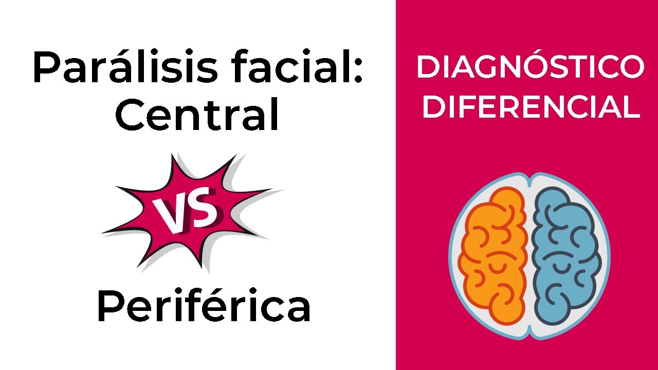 diferencia entre acv y paralisis facial