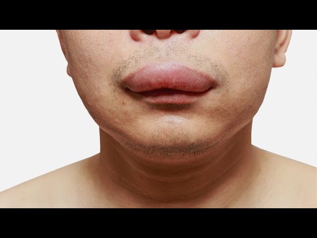 hinchazon repentina de labios dela boca