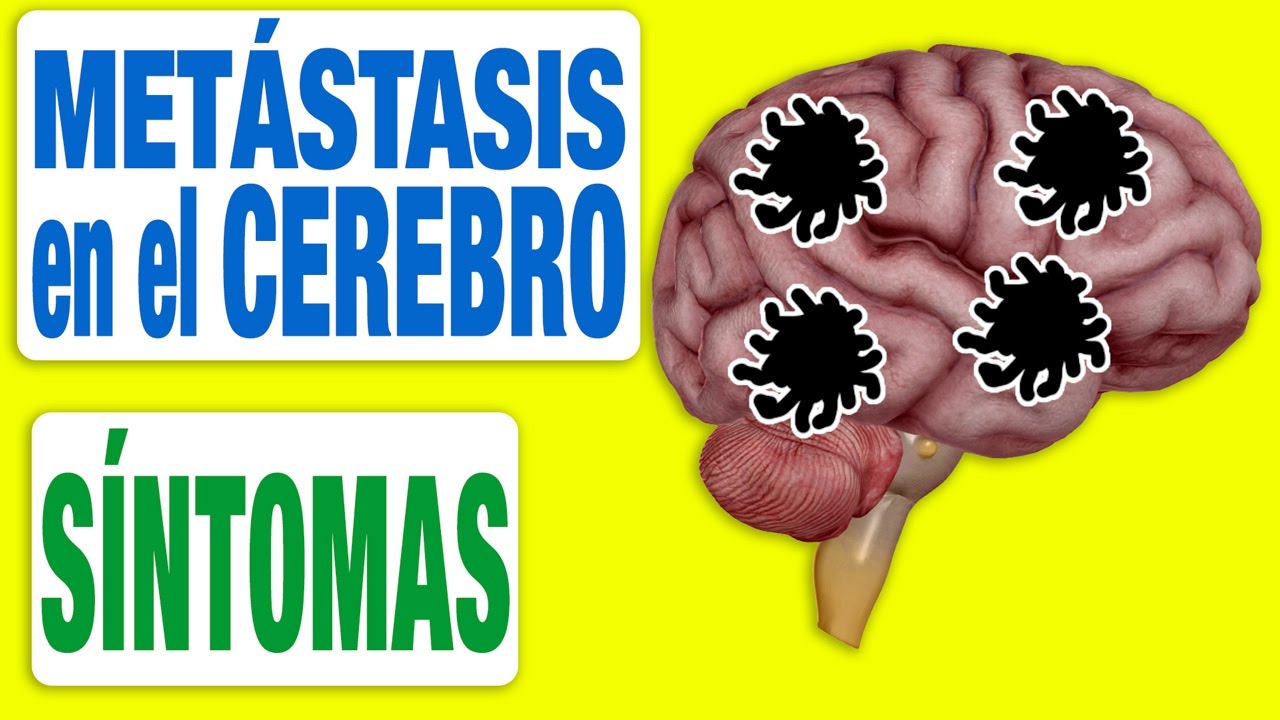 metastasis en la cabeza esperanza de vida