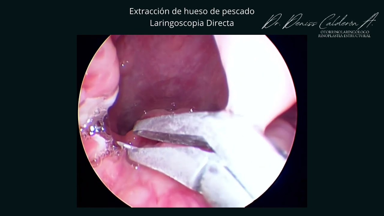 palo para mirar la garganta