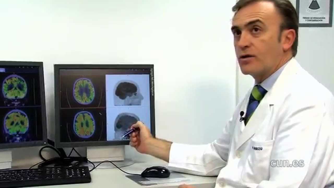 tomografia por emision de positrones alzheimer