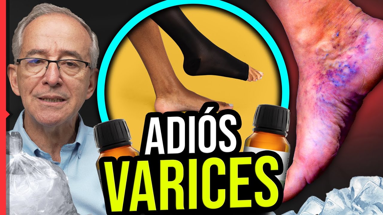como eliminar las varices de forma natural