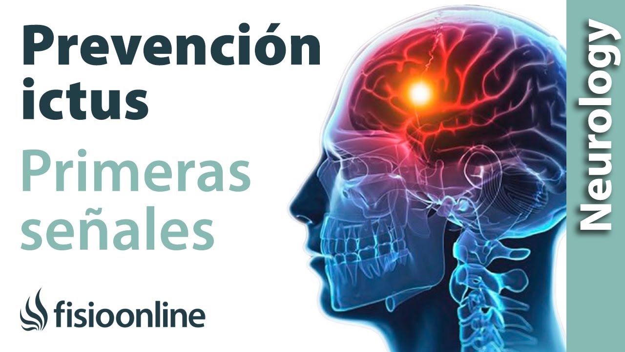 como saber si te esta dando un ictus
