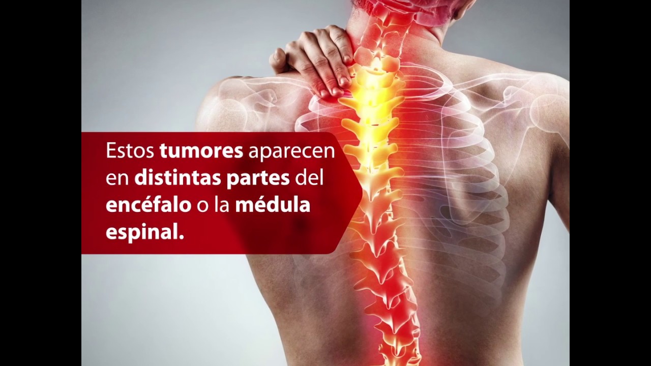 tumores del sistema nervioso central sintomas