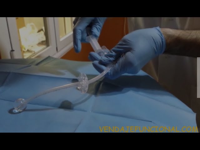 cada cuanto se cambia una sonda de gastrostomia