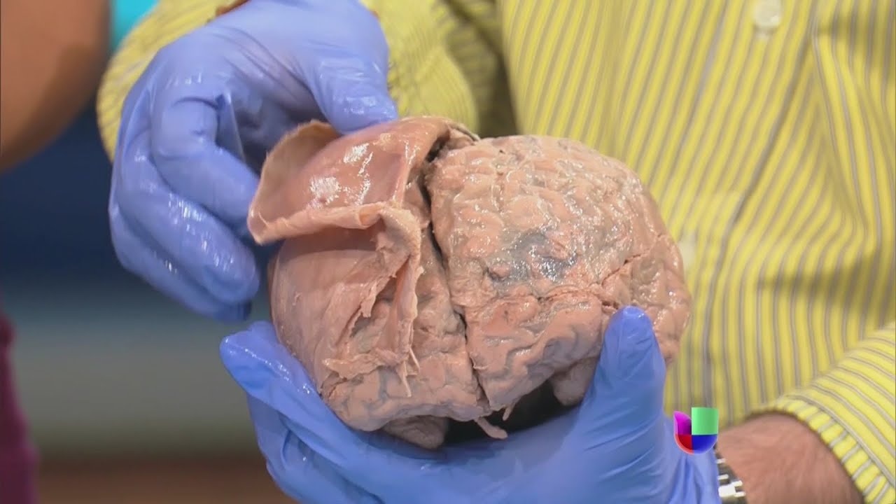 cerebro de una persona con alzheimer