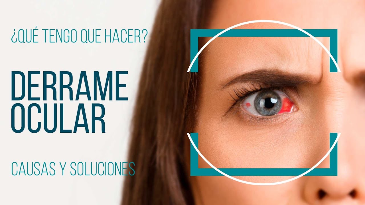 derrame en el ojo y dolor de cabeza