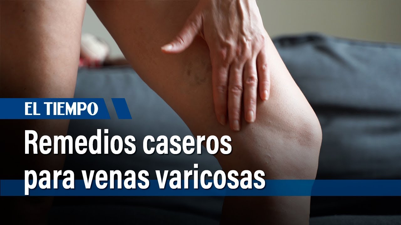hierbas naturales para curar las varices