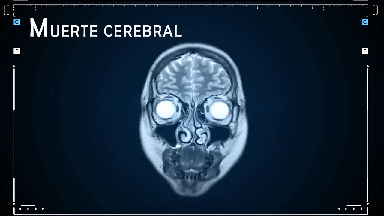 por que se da la muerte cerebral