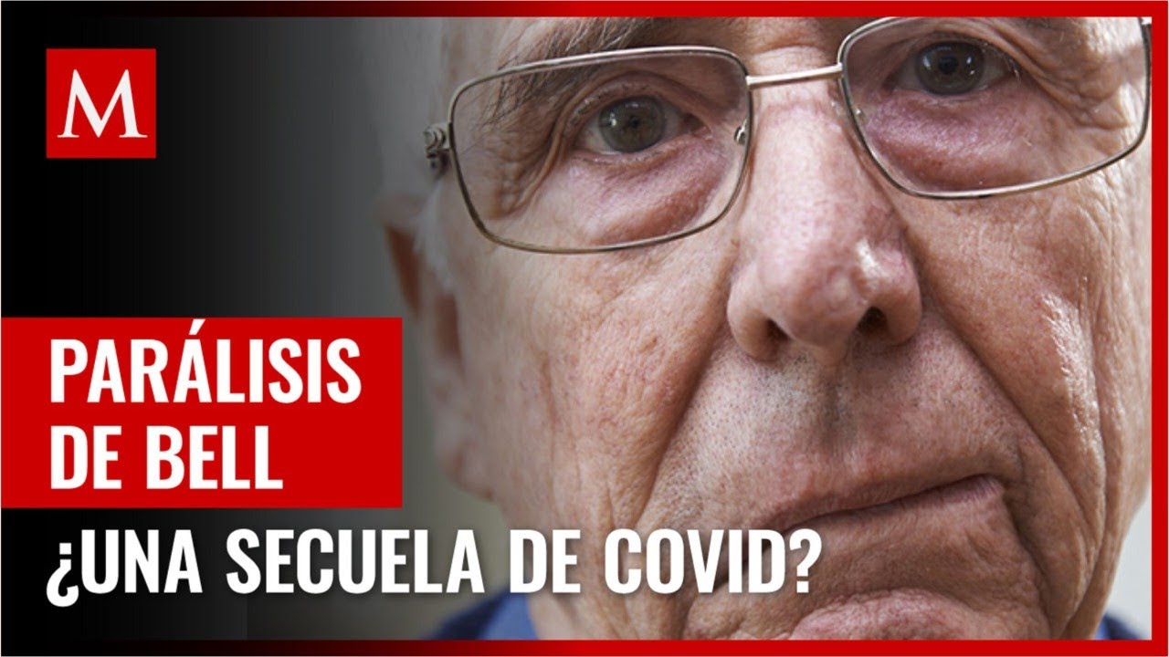 qué es la parálisis de bell
