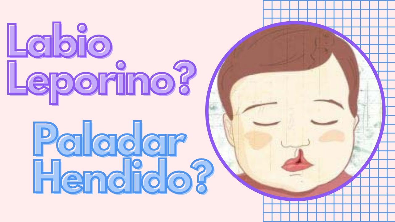 que es labio leporino y paladar hendido