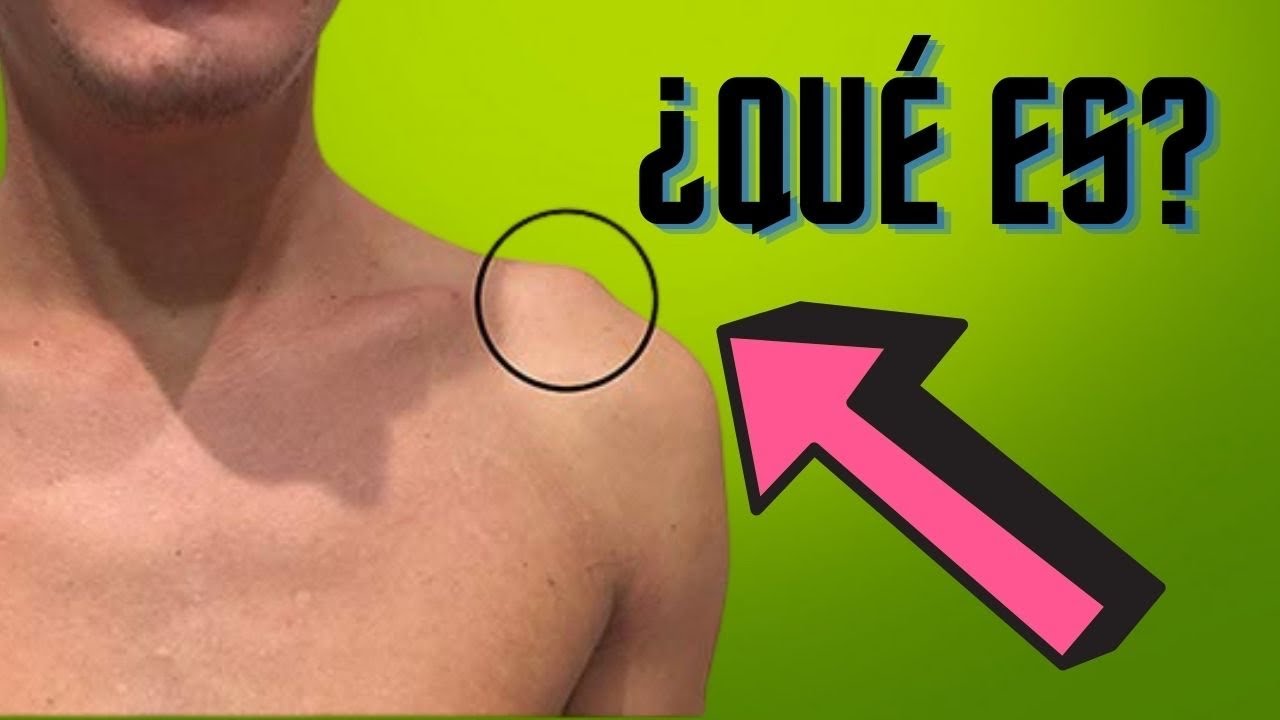 tengo una bola en el hombro